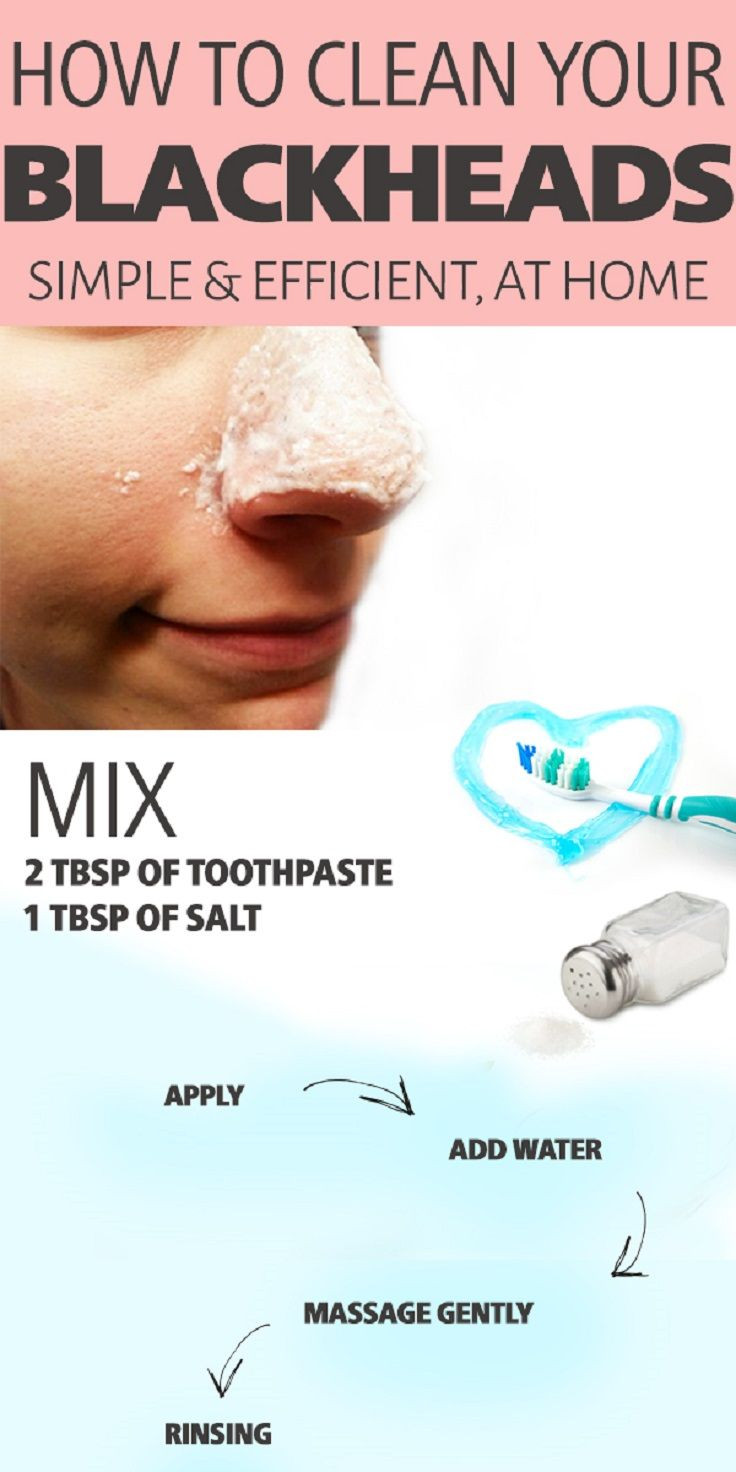Best Face Mask For Blackhead Removal DIY
 Pin on 17 BEAUTY