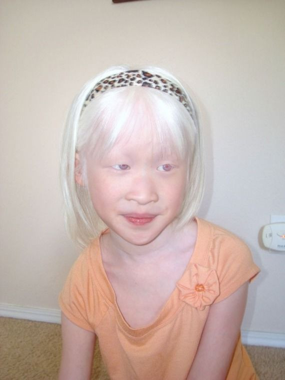 Kids With White Hair
 Chinese albino child girl