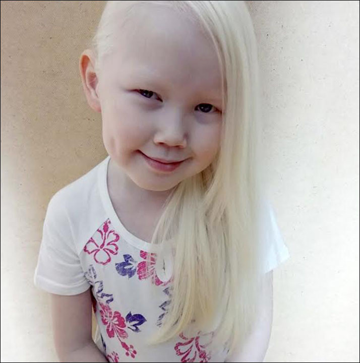 Kids With White Hair
 Albino girl known as Snow White be es as internet