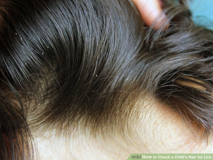Lice In Baby Hair
 How to Check a Child s Hair for Lice