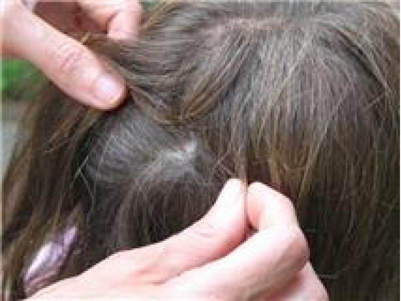 Lice In Baby Hair
 Your Child Has Lice Don t Panic Pediatrician Says