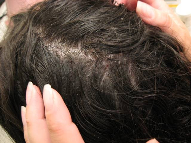 Lice In Baby Hair
 Nits head lice Causes symptoms treatment Nits head lice
