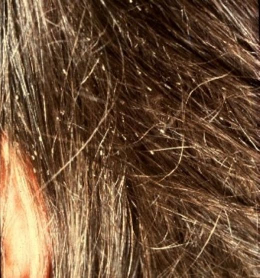 Lice In Baby Hair
 Does My Child Have Head Lice Yikes