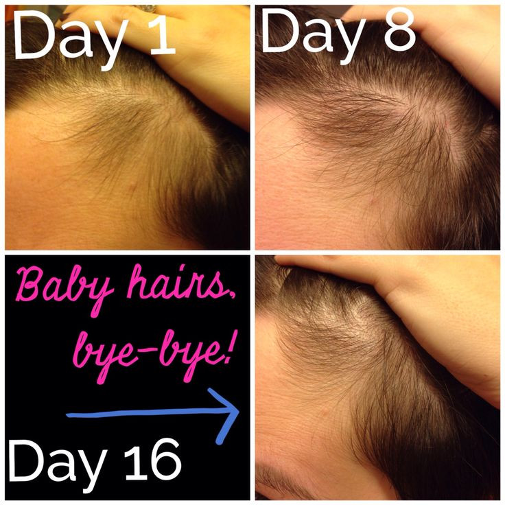 Post Baby Hair Loss
 Best 25 Postpartum hair loss ideas on Pinterest