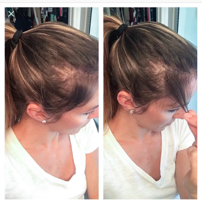 Post Baby Hair Loss
 Post baby hair blues – The Blog and the Beautiful